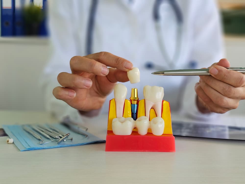 Close-up of a tooth model illustrating dental implants pros and cons and tooth replacement options.